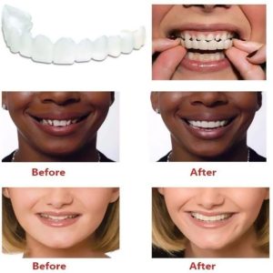 Snap-on Dentures Kit: Full Dentures, Partial Dentures, Removable Dentures